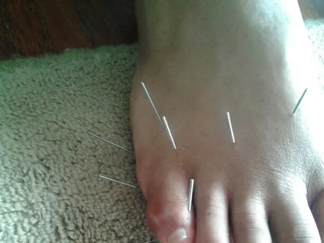 Things to Ponder Before Undergoing a Tummy Tuck Procedure